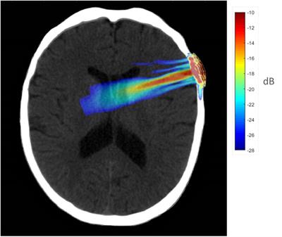 Frontiers | Transcranial Focused Ultrasound To The Right Prefrontal ...